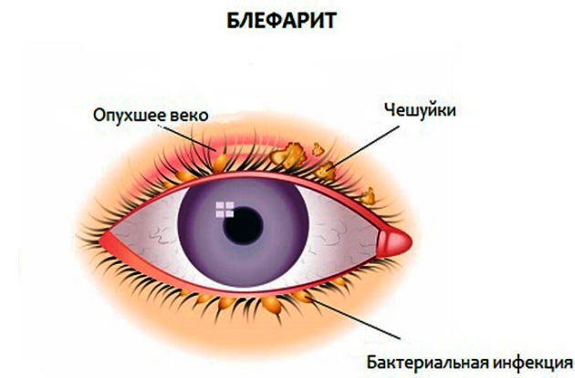 Заболевание Блефарит или воспаление века