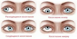 Факторы риска косоглазия — Страбизм