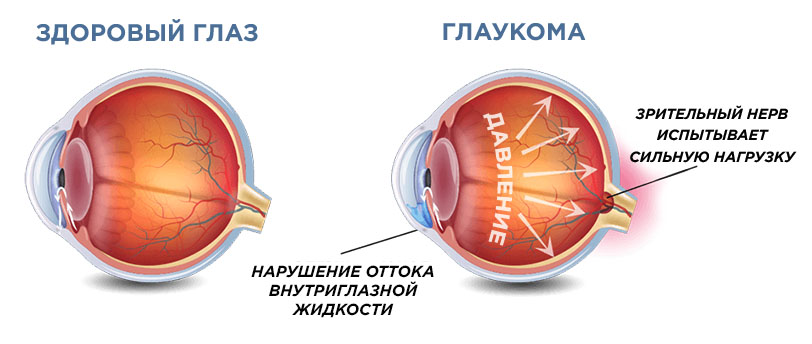 Чем опасна глаукома?